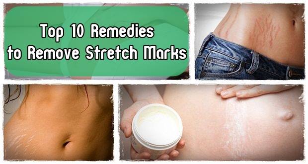 Top 10 Remedies to Remove Stretch Marks