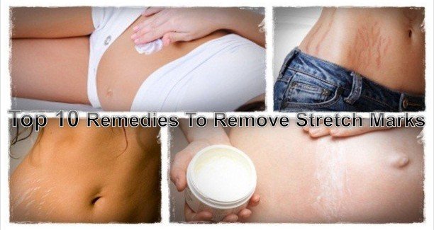 Top 10 Remedies to remove stretch marks