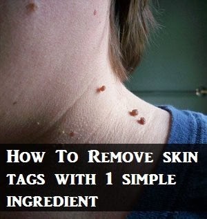 skin-tags