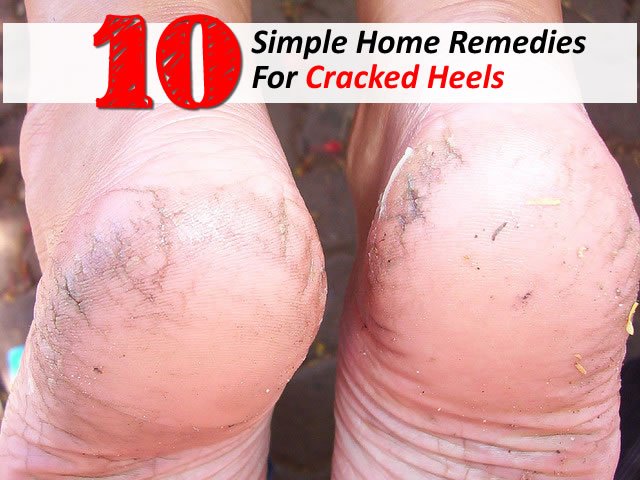 10 Simple Home Remedies For Cracked Heels