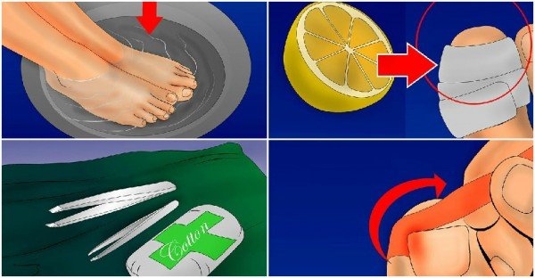 How to Get Rid of Ingrown Toenails – Natural Home Remedy (Video)