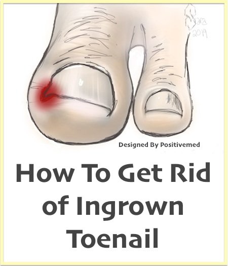 How to Get Rid of Ingrown Toenails