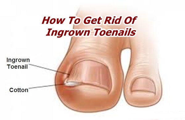 ingrown toenails