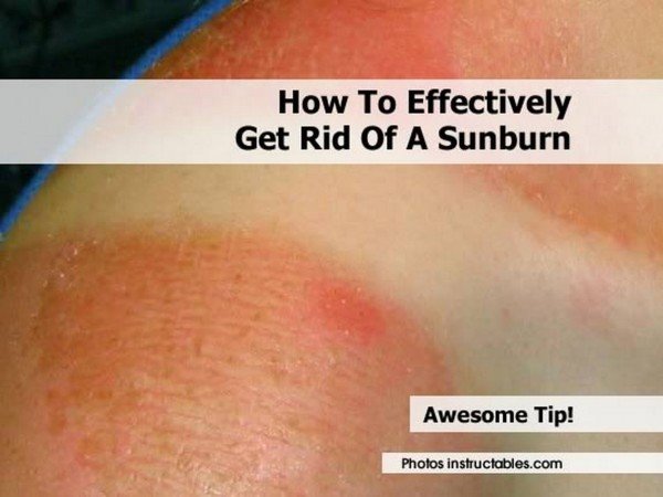How To Effectively Get Rid Of A Sunburn