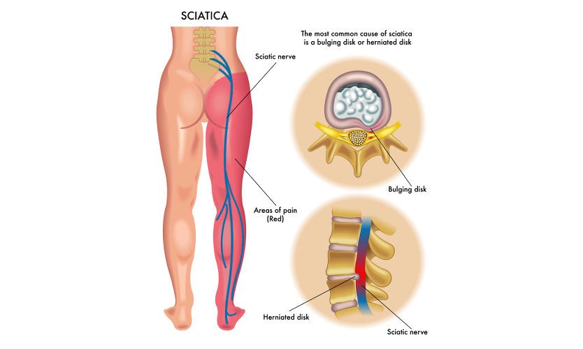 7 Yoga Poses to Soothe Sciatic Nerve Pain