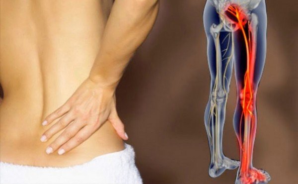 8 Home Remedies For Sciatica Pain That Actually Work