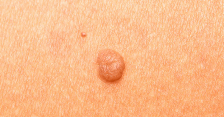 How to Remove Skin Tags at Home with One Ingredient
