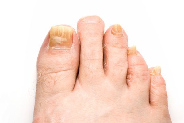 Home Remedies to Get Rid Of Toenail Fungus