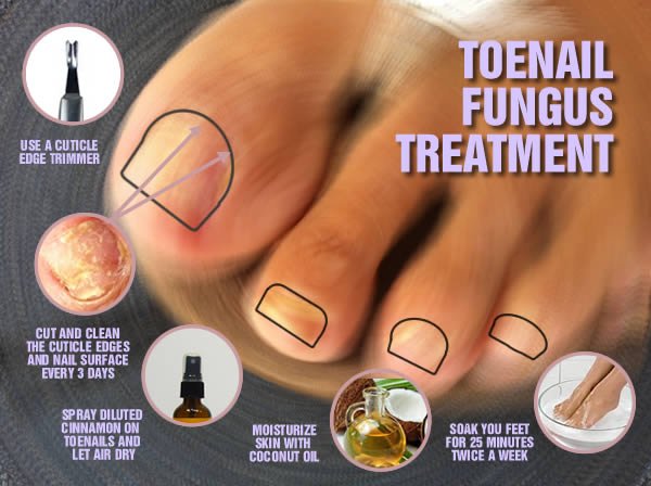 Top 31 Best Home Remedies for Nail Fungus - Get Rid Of Fungus Now - Nail  Care Palace