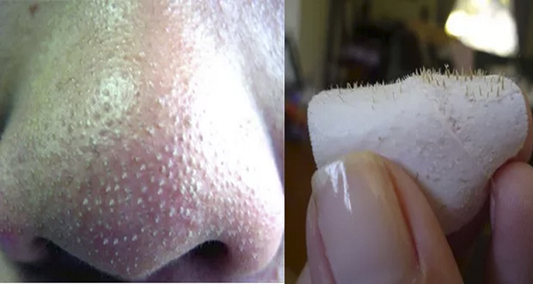 Home Remedy to Get Rid Of Blackheads On Nose Fast