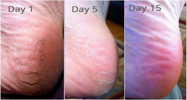 After Doing THIS, You Will Never Suffer From Cracked Heels, Corns and Calluses Again