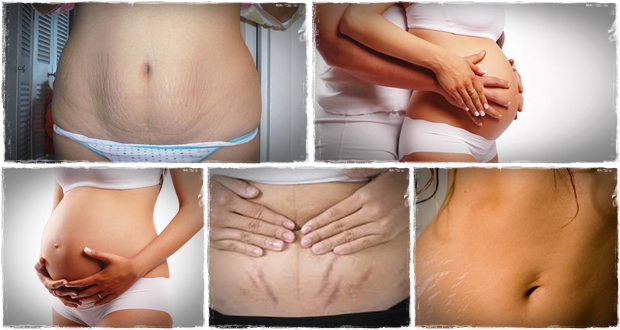 Top 10 Remedies to Remove Stretch Marks