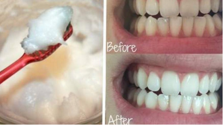 How to Oil Pull for Teeth Whitening and Body Health