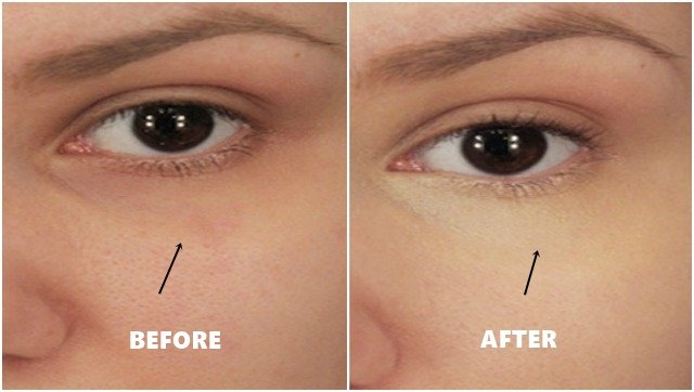 How To Remove Dark Circles Under eyes with one ingridients