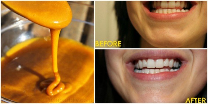 How To Whiten Your Teeth With Turmeric Naturally (Video)